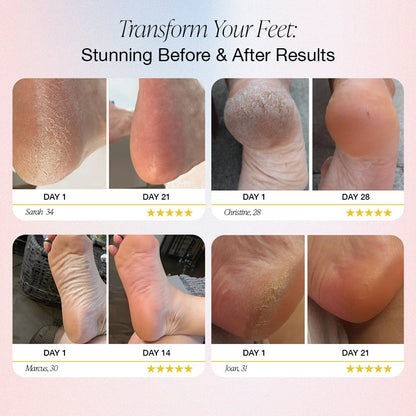 Dermave™ - Electric Foot Callus Remover